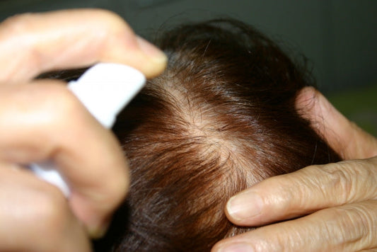 女性のヘアロス対策完全ガイド:原因・予防・効果的な治療法まで