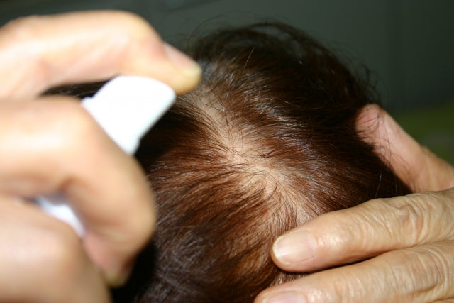 女性のヘアロス対策完全ガイド：原因・予防・効果的な治療法まで