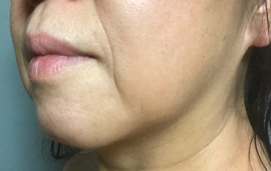 しわの原因と最新改善法｜紫外線・乾燥・生活習慣から美容医療まで徹底解説